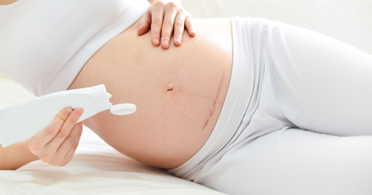 Tips to help fade C-section scars